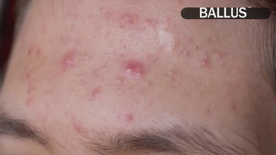  جهاز تنظيف المسام وشفط الرؤوس السوداء – العناية العميقة تبدأ من هنا  